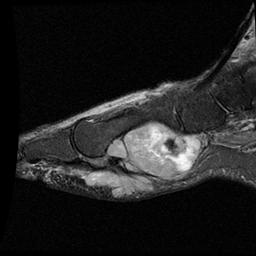 Synovial Sarcoma Foot MRI0001